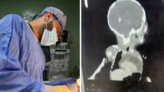 لم يُسجل منها سوى 22 حالة بالعالم..  نجاح أول عملية نادرة لطفلة حديثة الولادة بالعراق